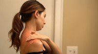 Newswise: How to Prevent and Treat Common Summer Rashes
