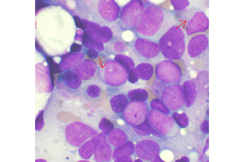 Bone marrow aspirate showing acute myeloid leukemia. Several blasts have Auer rods. Credit: Wikipedia myeloid leukemia