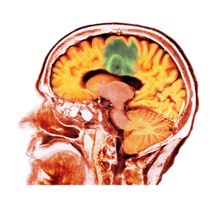 Glioblastoma brain cancer, CT scan