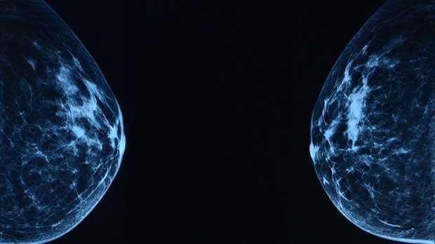 Changes detected in BRCA1 breast cells before they turn cancerous