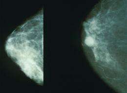 Mammograms showing a normal breast (left) and a cancerous breast (right). Credit: Wikipedia. breast cancer
