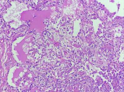 Scientists at a research center supported by FAPESP identified a non-inherited mutation in blood cells from a patient with GATA2 deficiency that may have prevented bone marrow failure and other clinical manifestations (lung tissue from patient with GATA2 deficiency, displaying pulmonary alveolar proteinosis and inflammatory lymphoplasmacytic infiltrate. Credit: : CTC Non-hereditary mutation acts as natural gene therapy in patient with rare disease