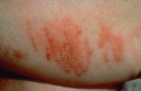 Newswise: How to Prevent and Treat Common Summer Rashes