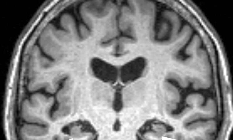 Brain MRI of a 72-year-old woman shows loss of volume of the hippocampus (arrows). The patient had all three characteristics, volume loss of the hippocampi, APOE4, and anxiety, found in the study to be associated with progression from mild cognitive impairment to dementia. Credit: Radiological Society of North America Anxiety associated with faster Alzheimer's disease onset
