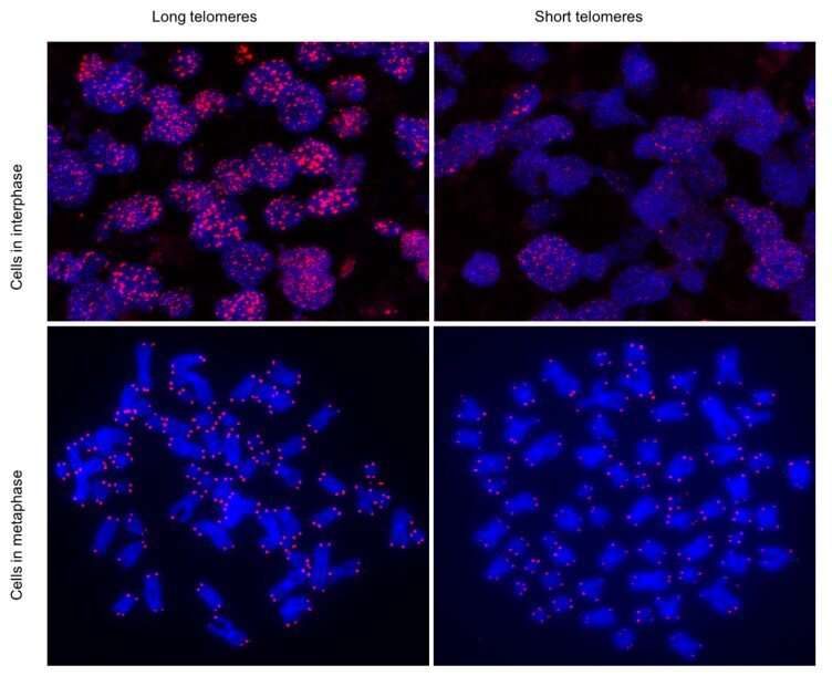 Human cells with long telomeres (left) and short telomeres (right). Top and lower panels show cells in interphase and in metaphase, respectively. Credit: CNIO Study links severe COVID-19 disease to short telomeres