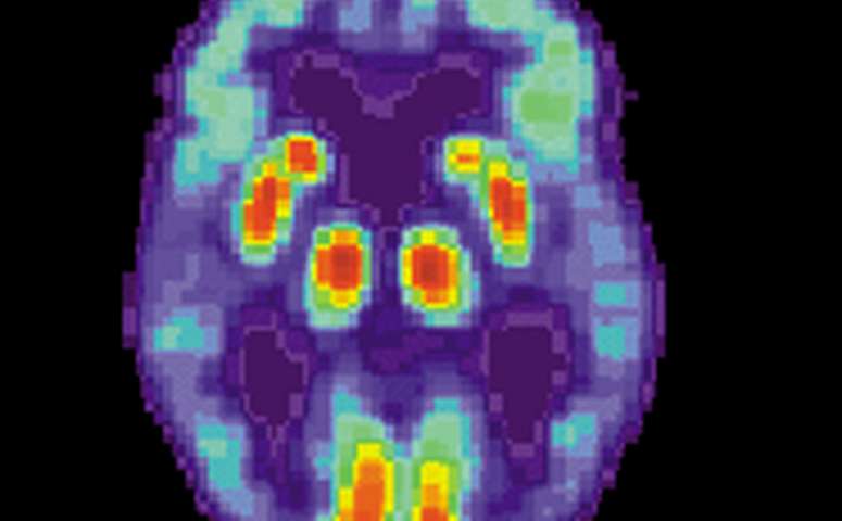 PET scan of a human brain with Alzheimer's disease. Credit: public domain Alzheimer's disease