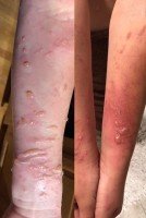 Newswise: How to Prevent and Treat Common Summer Rashes