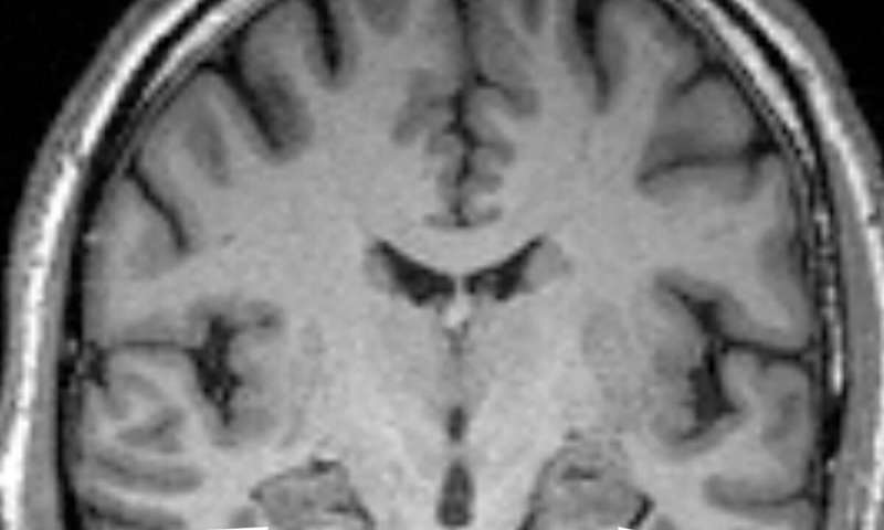 Anxiety associated with faster Alzheimer's disease onset