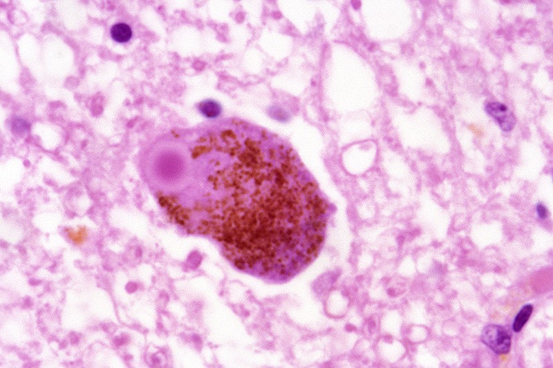 Light micrograph of a section through a neuron (nerve cell, red) containing a Lewy body (round, purple)