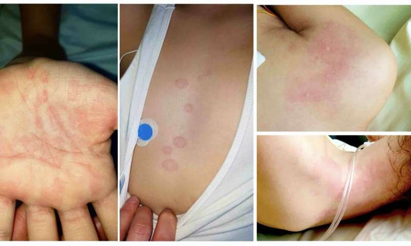 Immunotherapy, steroids had positive outcomes in children with COVID-related multi-system inflammatory syndrome