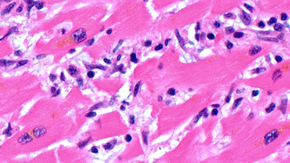 A light microscope image of cardiac tissue from a COVID-19 patient