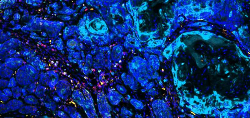 New research from Massachusetts General Hospital explores how the mutation-independent effect of environmental carcinogens leads to the recruitment of CD8+ T cells, the dominant antitumor cell type. Here, T cells (red and green) attack carcinogen-exposed breast cancer cells (light blue). Credit: Mei Huang, PhD Carcinogen-exposed cells provide clues in fighting treatment-resistant cancers