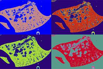 Australian researchers have identified 'natural killer' cells as an important component of anti-tumour immunity to lung cancer.Image: sections of lung containing tumours, by Dr Karen Doggett Credit: Walter and Eliza Hall Institute RethiNKing which immune cells are the best weapon against lung cancer