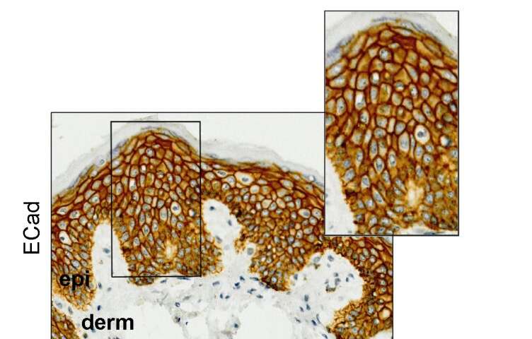 Immunohistochemical analysis of E-cadherin (ECad) and R-cadherin (RCad) in normal skin samples from breast cancer patients before starting capecitabine treatment. Unlike ECad (top), RCad (bottom) expression is mostly observed in the suprabasal epidermal layers, which are affected in the hand-foot syndrome. Credit: CNIO Researchers identify genetic factors associated with hand-foot syndrome in chemotherapy with capecitabine